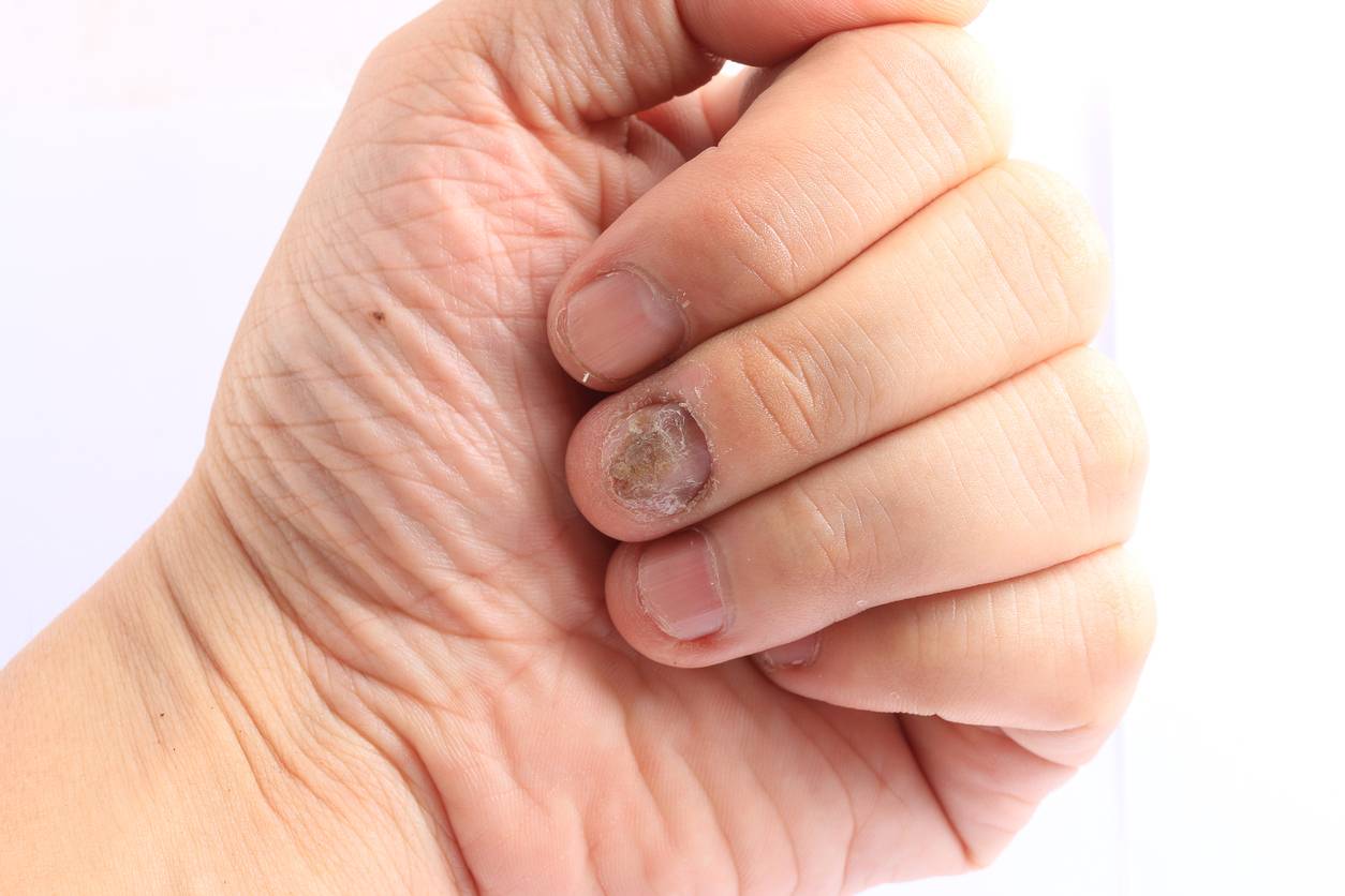 symptômes psoriasis ongle Plare